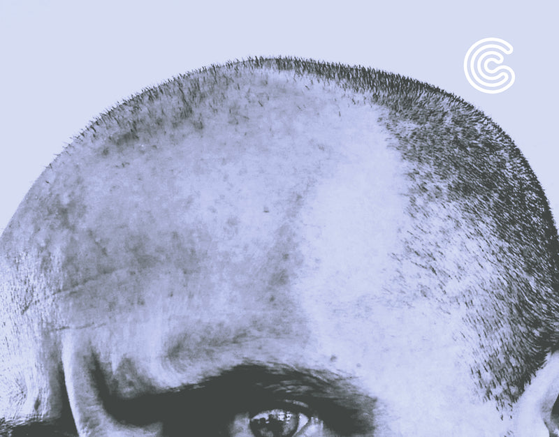 Going Bald?